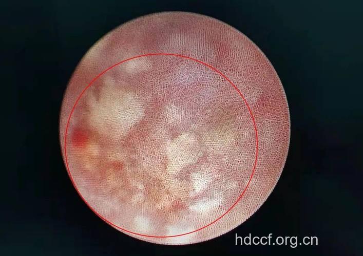 为什么男人精液会带血 是什么原因