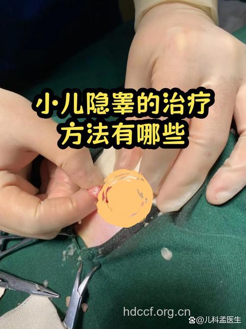 宝宝隐睾的激素治疗
