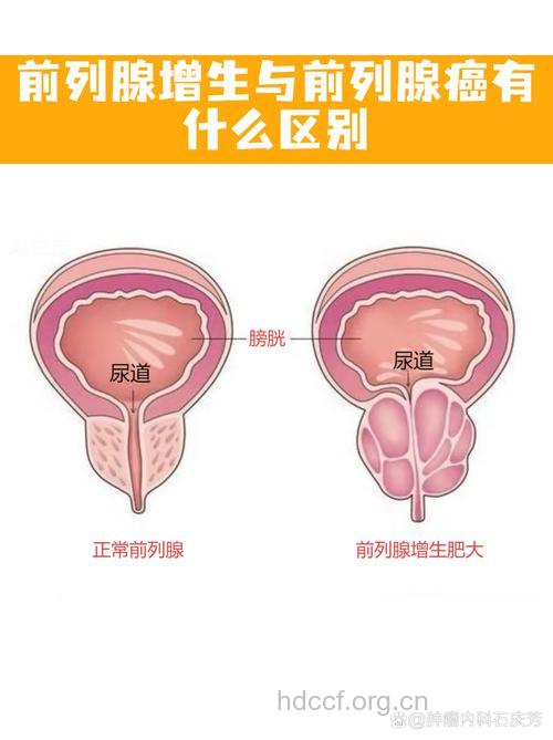 节欲与前列腺增生关系