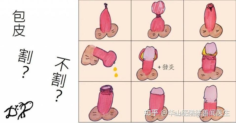 包皮过长怎么治 3个方法效果好