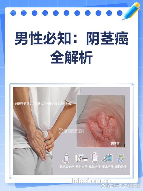 阴茎癌有何危害 可多种方法配合治疗