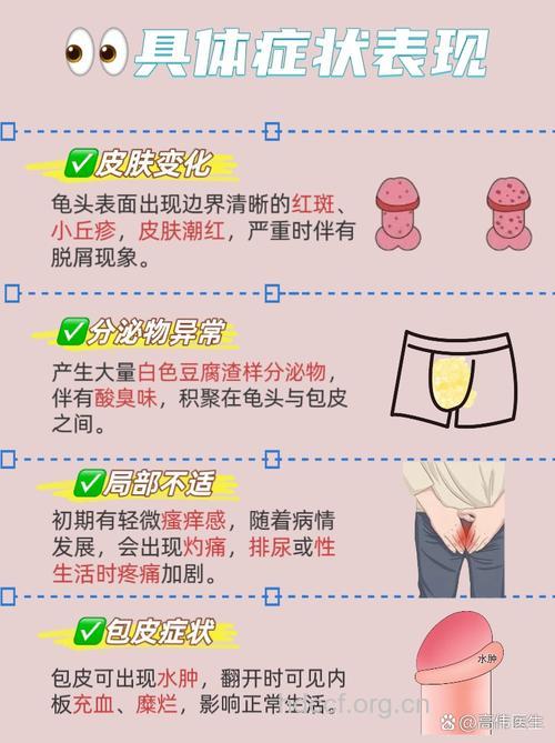 念珠性龟头炎治疗方法竟是这4个
