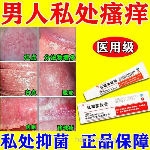 得了龟头炎怎么办 用什么药治疗