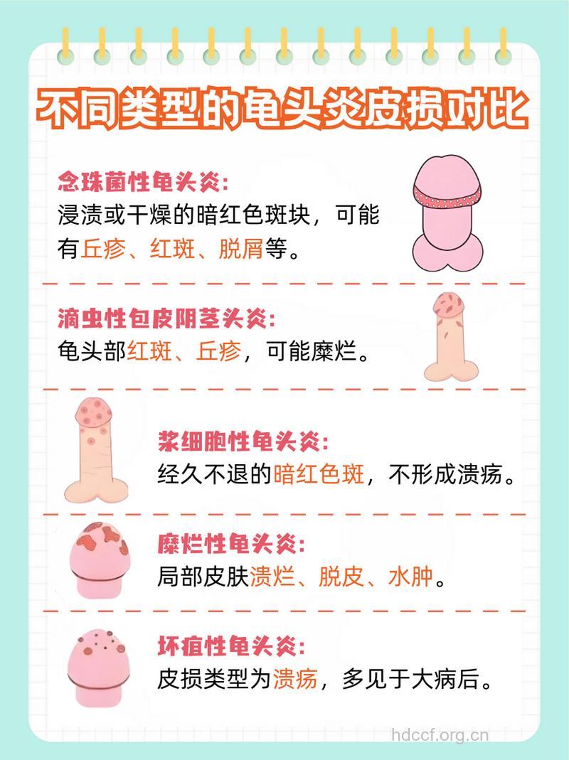 龟头炎的症状都有哪些