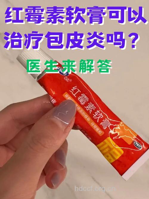 龟头炎用什么药膏 外用内服同治