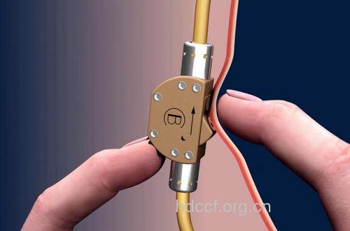 德国木匠发明“精子开关” 男人不用结扎?