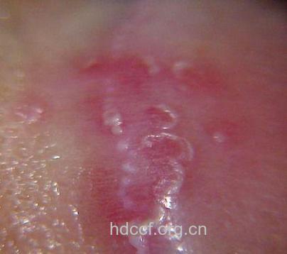 男性包皮龟头炎有哪些症状