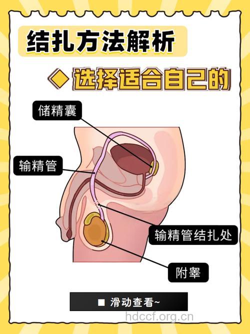 男性选择结扎该知道的事