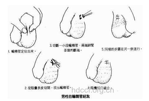男性结扎就等于被阉割?