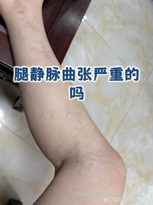 静脉曲张引发的婚姻危机