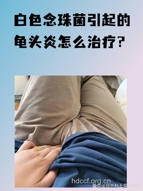 念珠性龟头炎 中西医及民间疗法大全