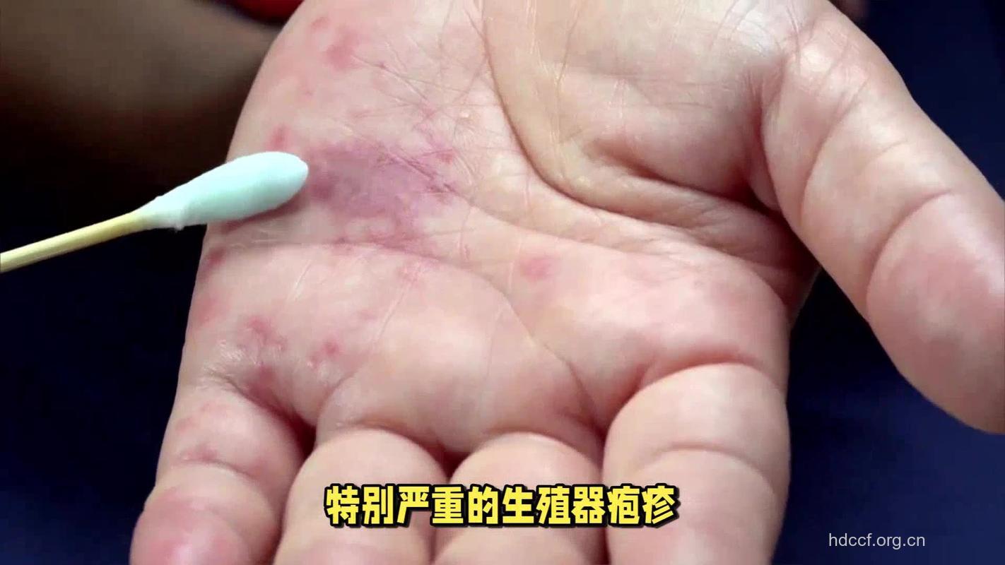 男性生殖器感染的常见症状