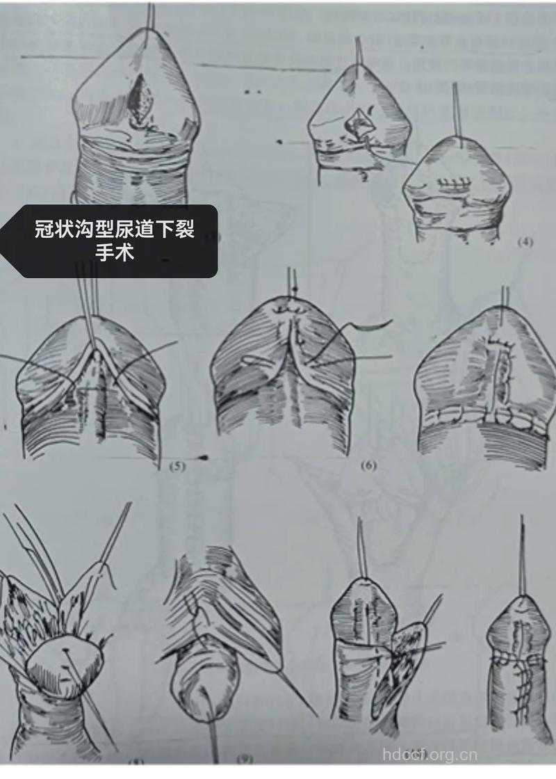 尿道下裂如何整形呢