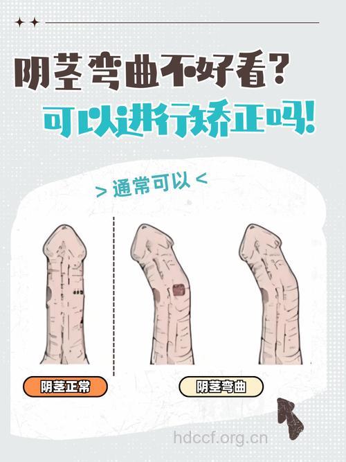 男性阴茎弯曲怎么办