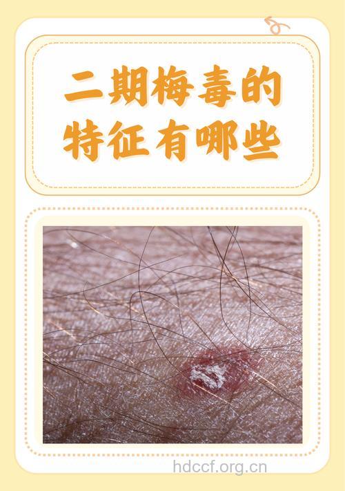 二期梅毒的主要症状 可分为3大点