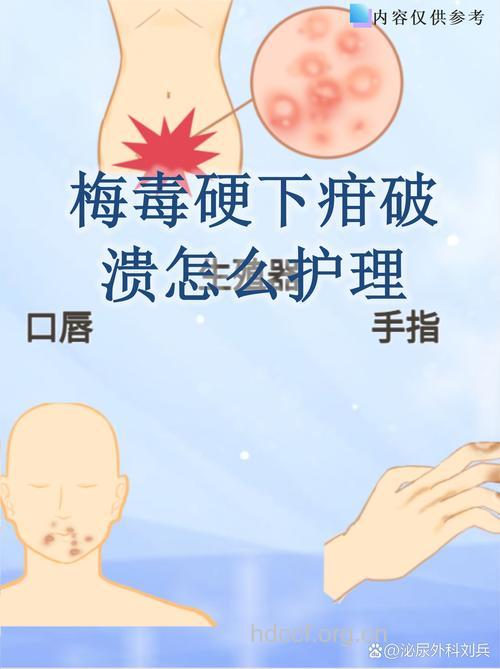 一期梅毒的症状有哪些 如何治疗护理
