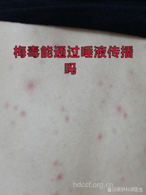 真相 梅毒唾液传播吗