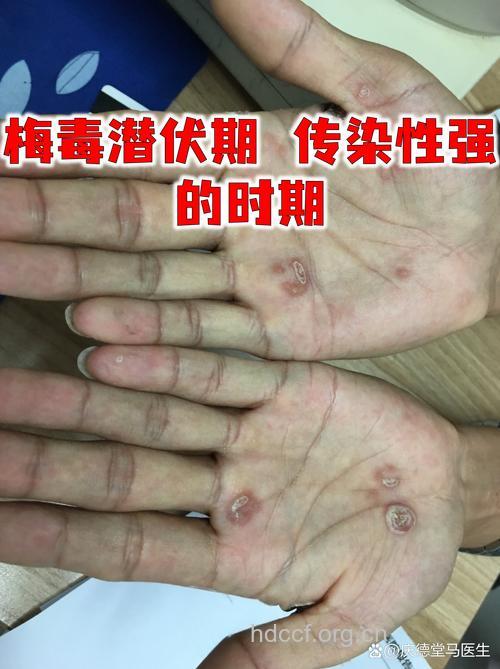 梅毒潜伏期传染吗 梅毒有哪些症状