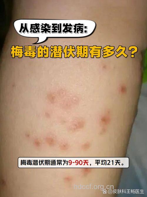 梅毒一般的潜伏期有多长