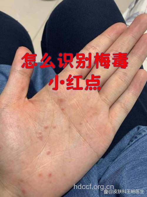 这些竟是梅毒最常见的症状