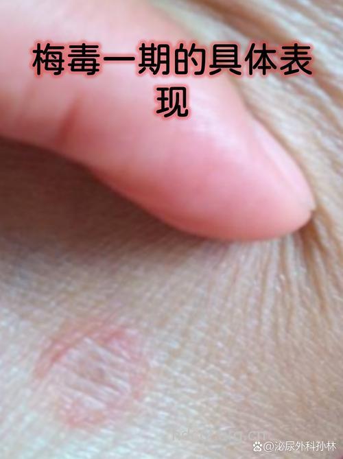 最常见的梅毒症状表现