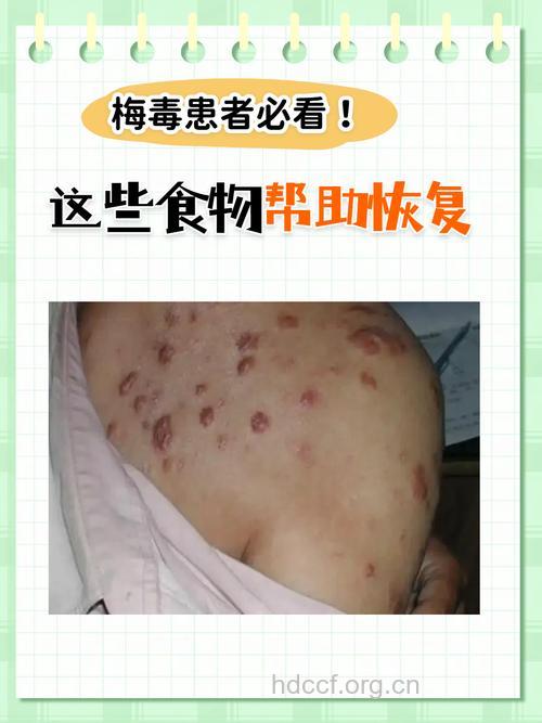 梅毒能治愈么 合理的饮食有利于梅毒康复