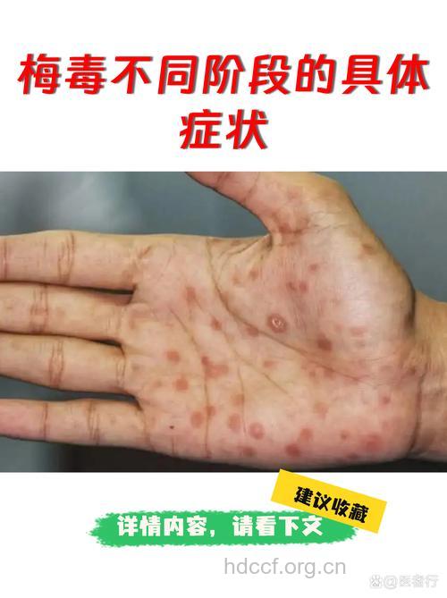 男性患梅毒 不同时期有不同症状