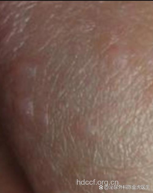 龟头炎的早期症状表现