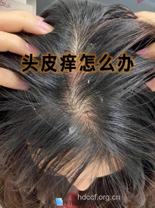 头皮屑猛增？当心是梅毒
