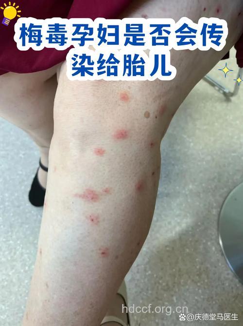 梅毒孕妇会把梅毒传给胎儿?