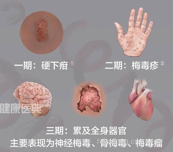 外阴自觉疼痛 女性预防梅毒的7种方法