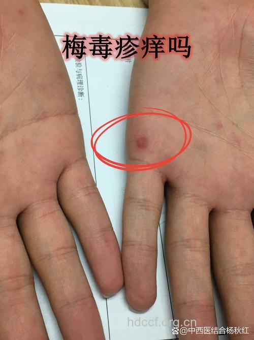 患上梅毒有哪些症状 梅毒能彻底治愈吗