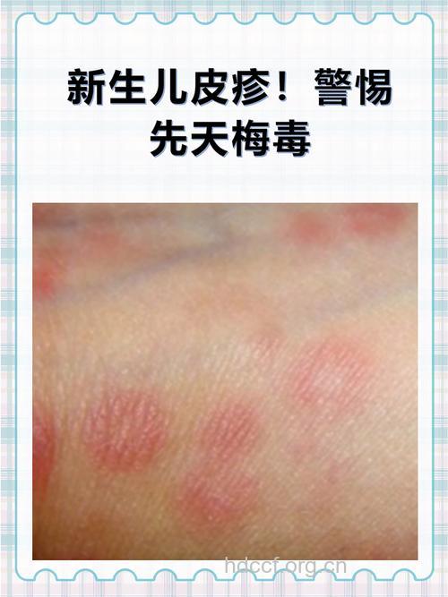 梅毒孕妇一定会生出先天性梅毒婴儿吗