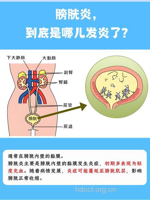 详解膀胱炎的各种分类