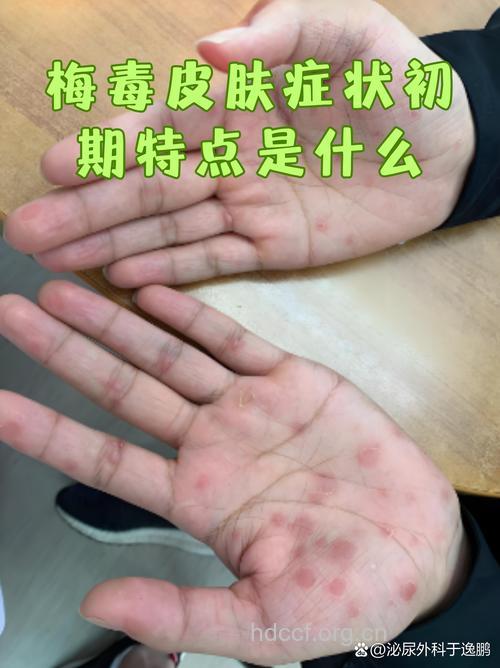 梅毒的三个时期的临床表现