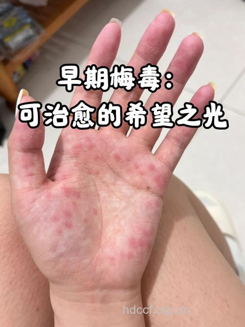 彻底治愈梅毒的希望有多少