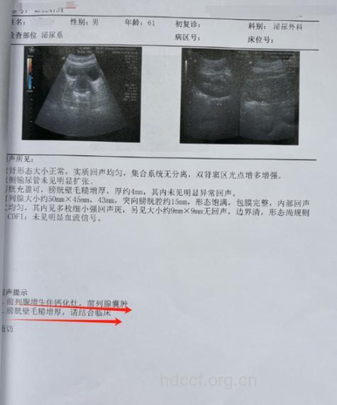 前列腺检查单子怎么看