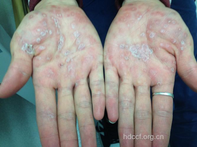 梅毒各个时期的异常表现