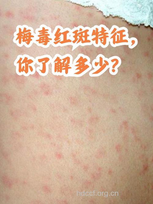 梅毒有哪些具体的表现