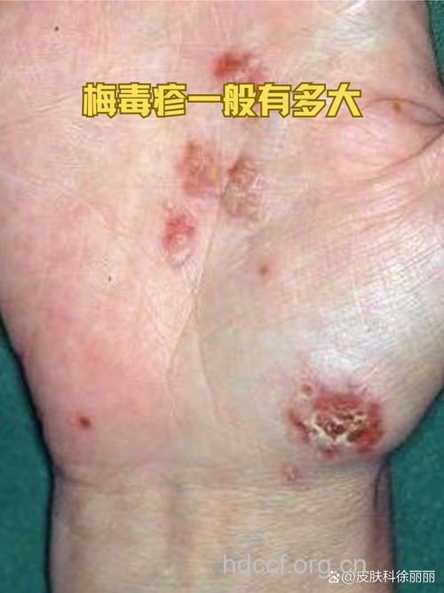 梅毒患者在各个时期的异常反应