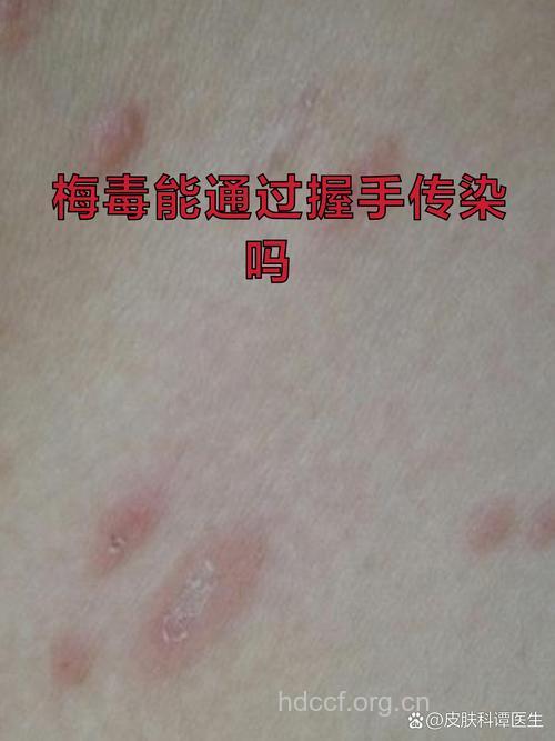梅毒误区 握手不会传染梅毒吗
