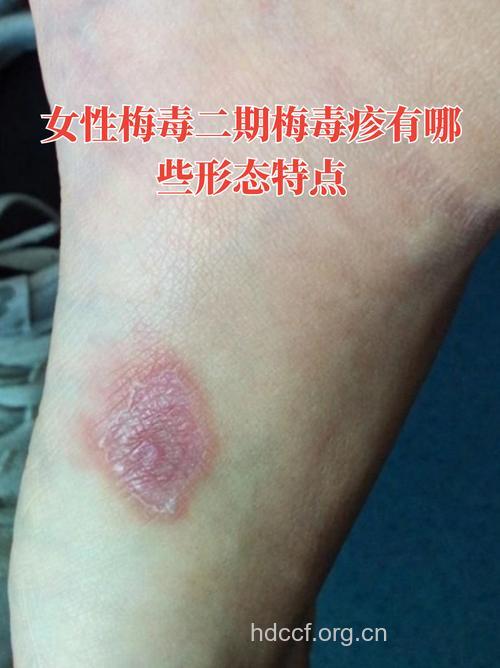 梅毒疹 二期梅毒的典型症状