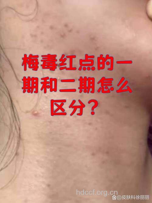 一期梅毒和二期梅毒症状区别