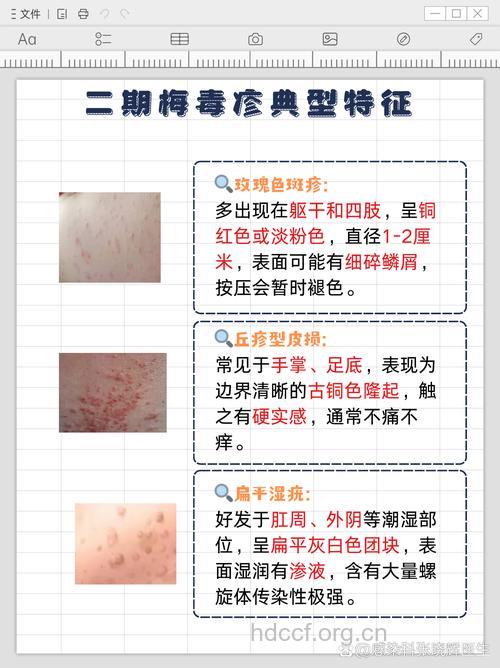 如何鉴别二期梅毒？