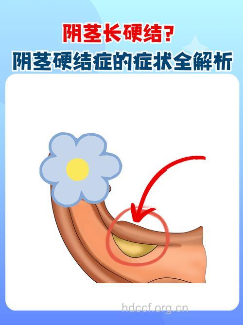 阴茎硬结伤害大 中老年人最高发