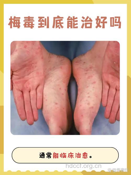 疾病百科 一期梅毒能治愈吗