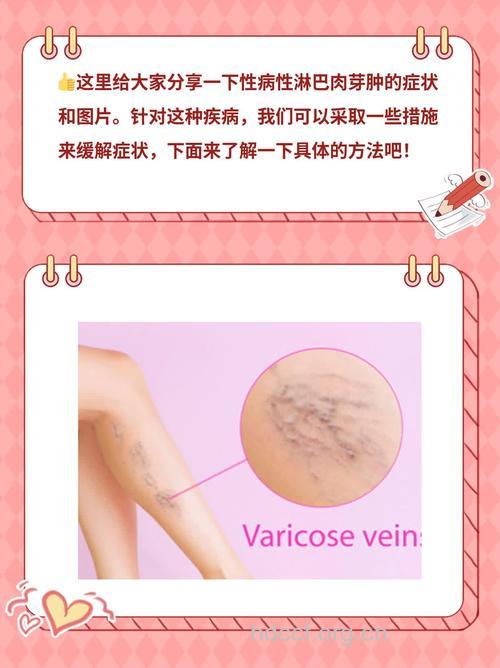 疾病百科 性病性淋巴肉是什么样子的