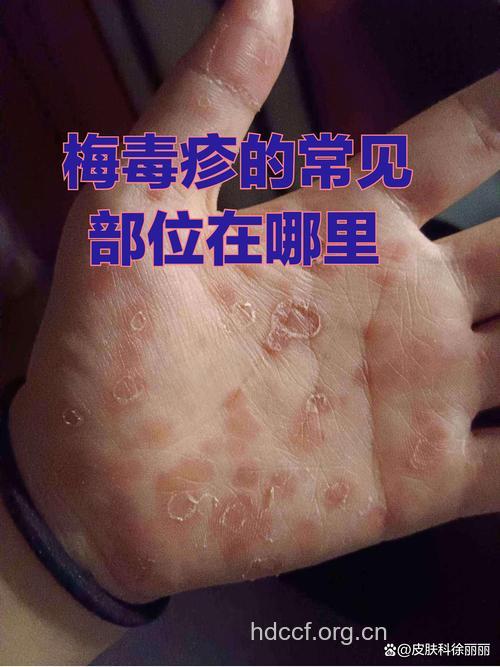 二期梅毒症状