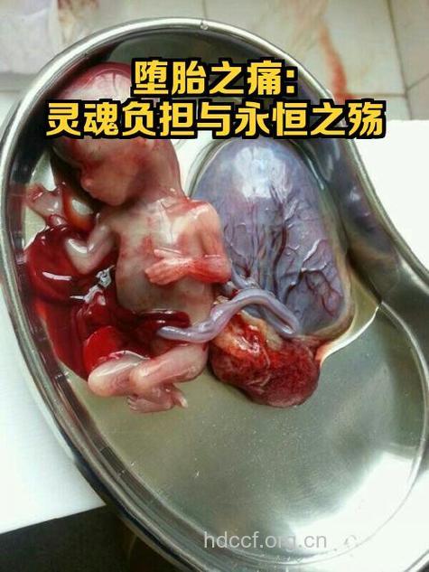 孕妇染梅毒 胎儿胎死腹中