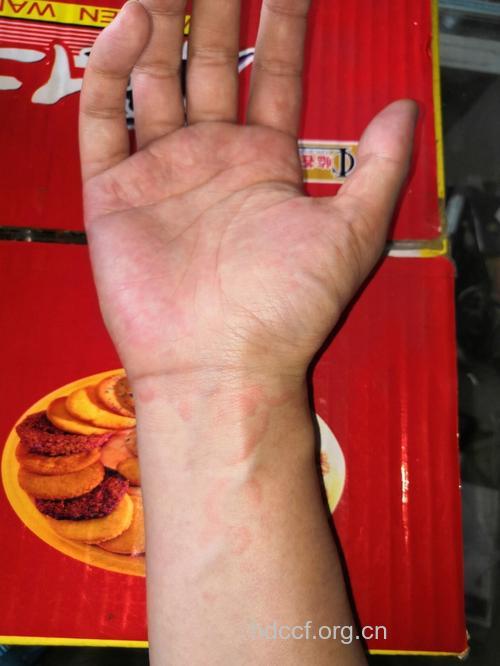 女性手掌红色疹子竟是梅毒疹